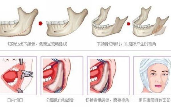 下<a href=http://www.bolangguoji.com/listinfo-644-0.html target=_blank class=infotextkey>頜骨整形</a>危險嗎