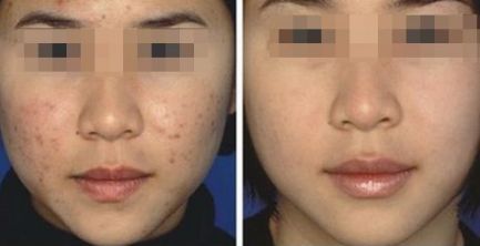 激光去除痘疤有效果嗎