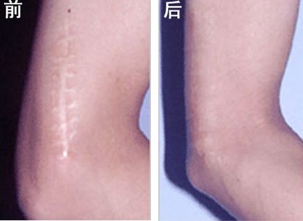 怎樣區(qū)分疤痕的種類
