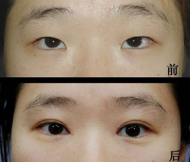 埋線<a href=http://www.bolangguoji.com/listinfo-724-0.html target=_blank class=infotextkey>雙眼皮</a>需要拆線嗎
