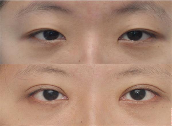 做個(gè)<a href=http://www.bolangguoji.com/listinfo-711-0.html target=_blank class=infotextkey>開眼角</a><a href=http://www.bolangguoji.com/listinfo-724-0.html target=_blank class=infotextkey>雙眼皮</a>多少錢