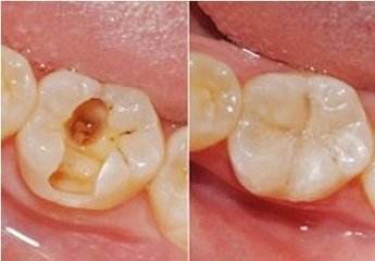 補個牙齒要多少錢
