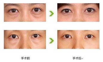 <a href=http://www.bolangguoji.com/listinfo-708-0.html target=_blank class=infotextkey>去眼袋</a>的缺點(diǎn)