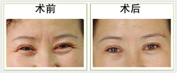 魚尾紋<a href=http://www.bolangguoji.com/listinfo-614-0.html target=_blank class=infotextkey>除皺</a>抗衰安全嗎