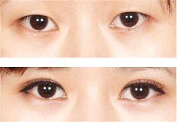 <a href=http://www.bolangguoji.com/listinfo-724-0.html target=_blank class=infotextkey>雙眼皮</a>經歷韓式點壓附對比照