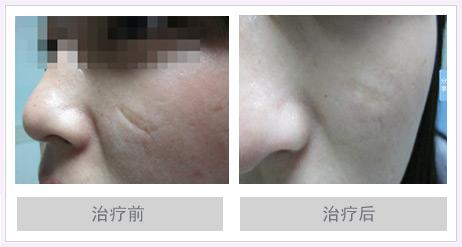 五種臉部疤痕修復辦法