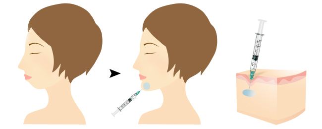 打下巴一般多少錢