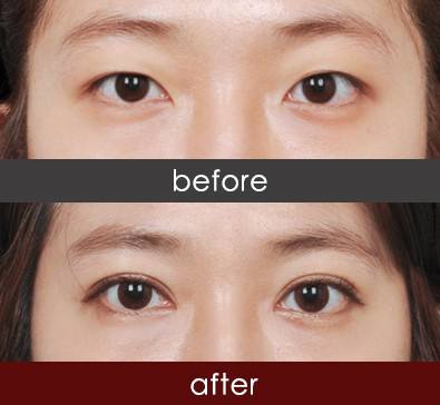 埋線<a href=http://www.bolangguoji.com/listinfo-724-0.html target=_blank class=infotextkey>雙眼皮</a>真的沒有危害嗎