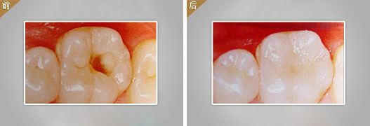 補一顆大牙要多少錢