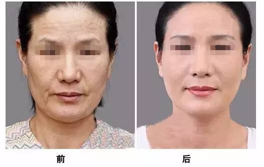 打完<a href=http://www.bolangguoji.com/listinfo-631-0.html target=_blank class=infotextkey>瘦臉</a>多久能吃海鮮