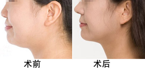 打<a href=http://www.bolangguoji.com/listinfo-631-0.html target=_blank class=infotextkey>瘦臉</a><a href=http://www.bolangguoji.com/listinfo-614-0.html target=_blank class=infotextkey>除皺</a>能吃辣嗎