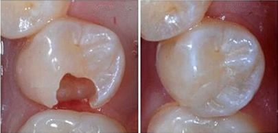 補一顆牙齒要多少錢
