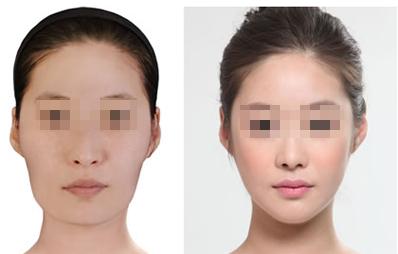 長春注射保妥適<a href=http://www.bolangguoji.com/listinfo-614-0.html target=_blank class=infotextkey>除皺</a>瘦型素<a href=http://www.bolangguoji.com/listinfo-631-0.html target=_blank class=infotextkey>瘦臉</a>需要多少錢