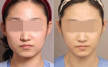 打一次<a href=http://www.bolangguoji.com/listinfo-631-0.html target=_blank class=infotextkey>瘦臉</a><a href=http://www.bolangguoji.com/listinfo-614-0.html target=_blank class=infotextkey>除皺</a>要多少錢