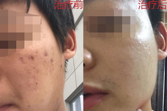 痘疤痘坑要怎么修復