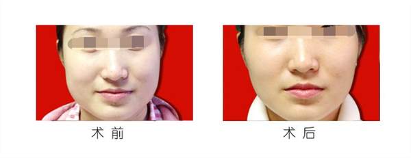 廣州<a href=http://www.bolangguoji.com/listinfo-629-0.html target=_blank class=infotextkey>下頜角</a>整形的術前如何準備