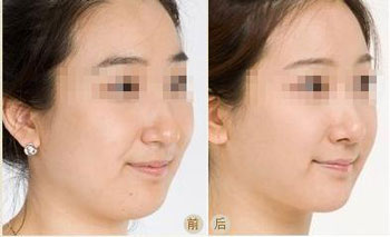 <a href=http://www.bolangguoji.com/listinfo-631-0.html target=_blank class=infotextkey>瘦臉</a><a href=http://www.bolangguoji.com/listinfo-614-0.html target=_blank class=infotextkey>除皺</a>效果較好的時間