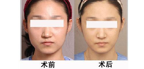 月經期打<a href=http://www.bolangguoji.com/listinfo-631-0.html target=_blank class=infotextkey>瘦臉</a><a href=http://www.bolangguoji.com/listinfo-614-0.html target=_blank class=infotextkey>除皺</a>有什么危害