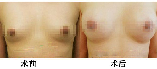 長沙假體<a href=http://www.bolangguoji.com/listinfo-618-0.html target=_blank class=infotextkey>隆胸</a>價格