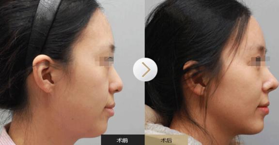 透明質酸的<a href=http://www.bolangguoji.com/listinfo-737-0.html target=_blank class=infotextkey>隆鼻</a>效果是否自然