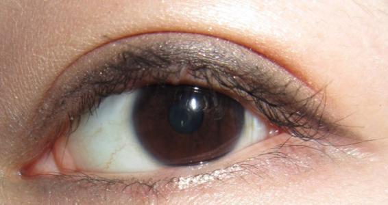 開(kāi)內(nèi)眼角手術(shù)后需要多久才能恢復(fù)呢