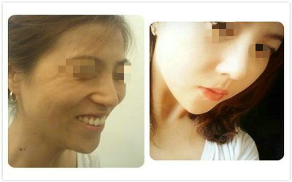做透明質酸<a href=http://www.bolangguoji.com/listinfo-737-0.html target=_blank class=infotextkey>隆鼻</a>注意事項？