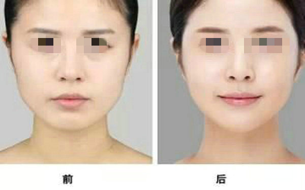 注射<a href=http://www.bolangguoji.com/listinfo-737-0.html target=_blank class=infotextkey>隆鼻</a>有什么壞處？