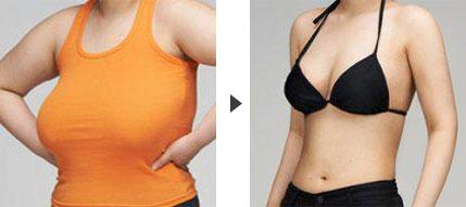 乳房大做手術要多少錢
