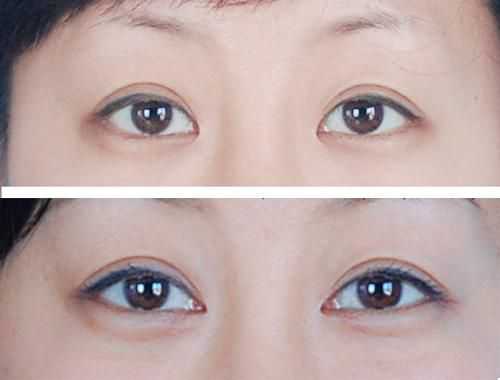 開個(gè)眼角需要多少錢