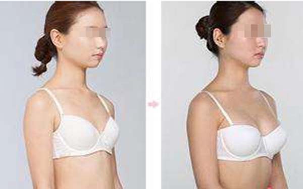 妙桃<a href=http://www.bolangguoji.com/listinfo-618-0.html target=_blank class=infotextkey>隆胸</a>材料特點