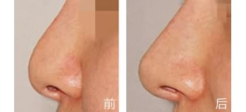 如何通過手術(shù)縮小<a href=http://www.bolangguoji.com/listinfo-754-0.html target=_blank class=infotextkey>鼻翼</a>