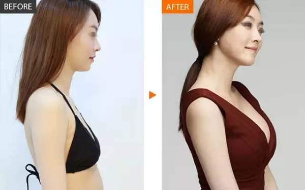 妙桃假體<a href=http://www.bolangguoji.com/listinfo-618-0.html target=_blank class=infotextkey>隆胸</a>的效果與優勢