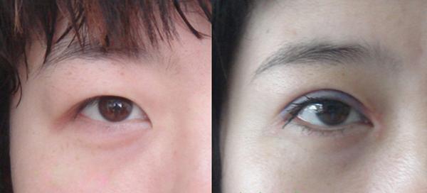 <a href=http://www.bolangguoji.com/listinfo-711-0.html target=_blank class=infotextkey>開眼角</a>圖片前后對比
