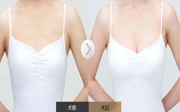 妙桃假體豐胸有什么優勢