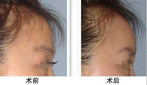額部整形注意事項(xiàng)有哪些