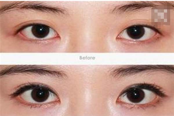 開內(nèi)眼角一定會留疤嗎