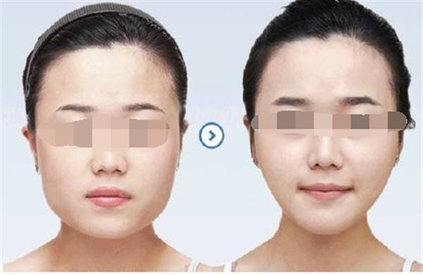 請問臉部輪廓整形要做什么手術