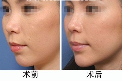 光纖<a href=http://www.bolangguoji.com/listinfo-682-0.html target=_blank class=infotextkey>溶脂</a><a href=http://www.bolangguoji.com/listinfo-631-0.html target=_blank class=infotextkey>瘦臉</a>要注意什么