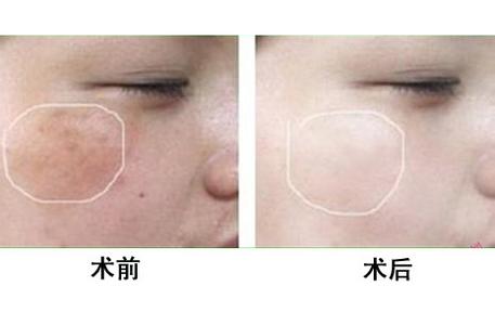 激光<a href=http://www.bolangguoji.com/listinfo-795-0.html target=_blank class=infotextkey>祛斑</a>幾天結痂脫落