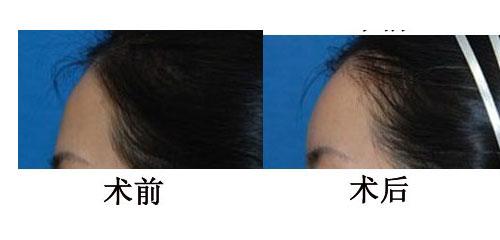 上海自體脂肪<a href=http://www.bolangguoji.com/listinfo-643-0.html target=_blank class=infotextkey>豐額頭</a>大概需要多少錢
