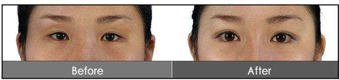 <a href=http://www.bolangguoji.com/listinfo-724-0.html target=_blank class=infotextkey>雙眼皮</a>手術(shù)失敗該如何補救呢