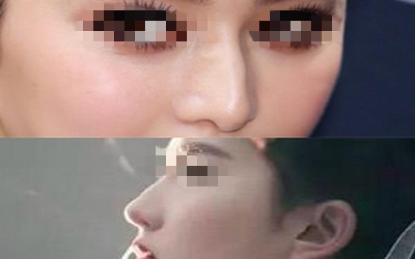 韓式<a href=http://www.bolangguoji.com/listinfo-737-0.html target=_blank class=infotextkey>隆鼻</a>一般多少錢