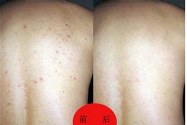 背上長粉刺怎么辦