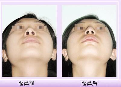 假體<a href=http://www.bolangguoji.com/listinfo-737-0.html target=_blank class=infotextkey>隆鼻</a>前期要準備些什么