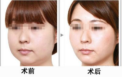 臉大小不一樣怎么辦
