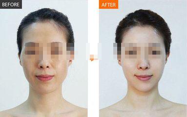 打水光<a href=http://www.bolangguoji.com/listinfo-770-0.html target=_blank class=infotextkey>嫩膚</a>的危害后遺癥