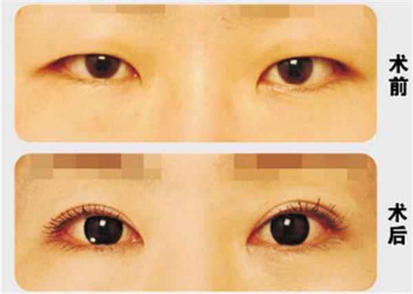 埋線和切開兩種<a href=http://www.bolangguoji.com/listinfo-724-0.html target=_blank class=infotextkey>雙眼皮</a>哪種好