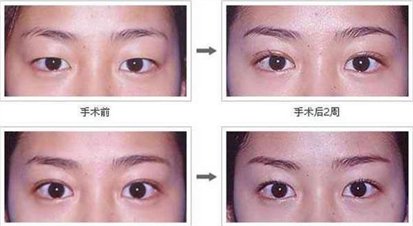 眼部抽脂前后對(duì)比