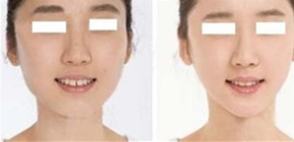 <a href=http://www.bolangguoji.com/listinfo-629-0.html target=_blank class=infotextkey>下頜角</a>整形恢復快嗎