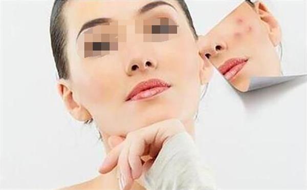 臉上痘印怎么辦